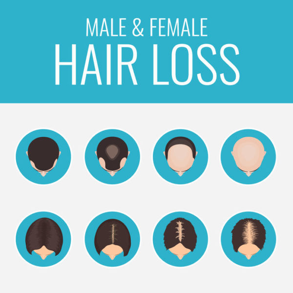 Male Or Female Pattern Baldness